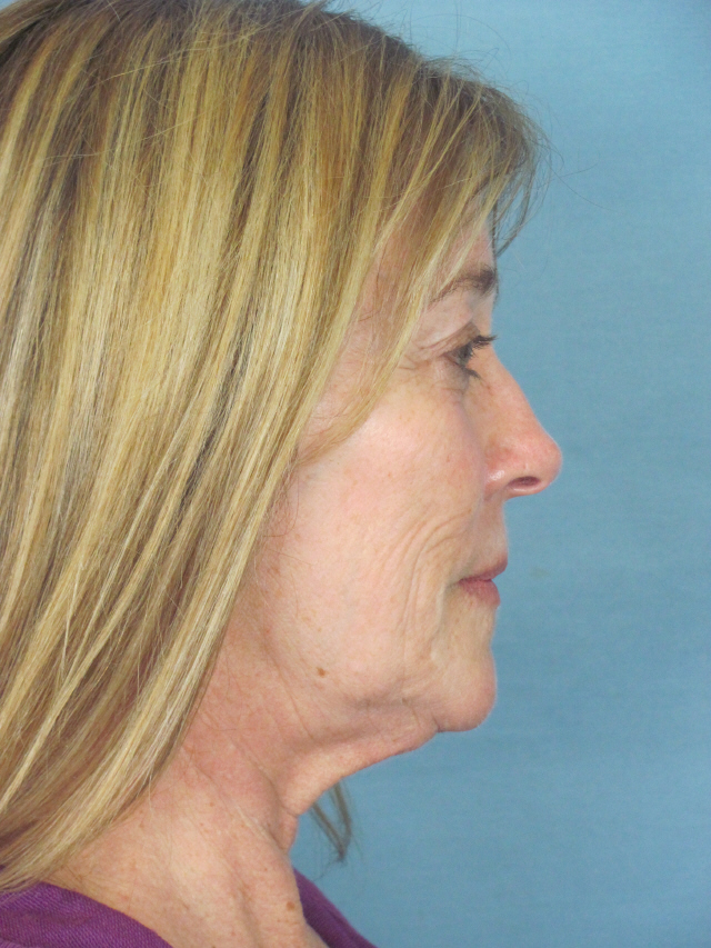 Charleston Custom Lift Facelift Before and After | Thomas Funcik MD