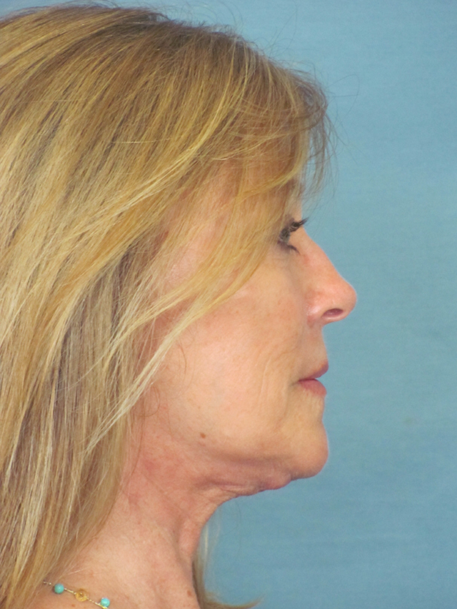 Charleston Custom Lift Facelift Before and After | Thomas Funcik MD