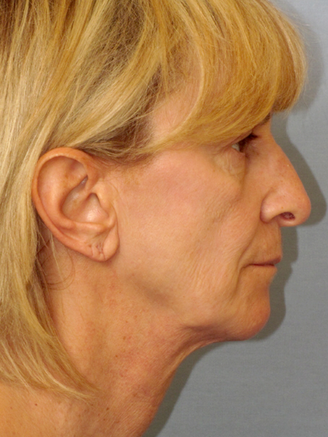 Charleston Custom Lift Facelift Before and After | Thomas Funcik MD