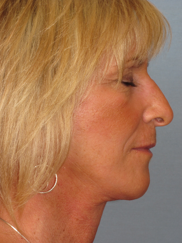 Charleston Custom Lift Facelift Before and After | Thomas Funcik MD