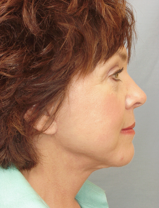 Charleston Custom Lift Facelift Before and After | Thomas Funcik MD