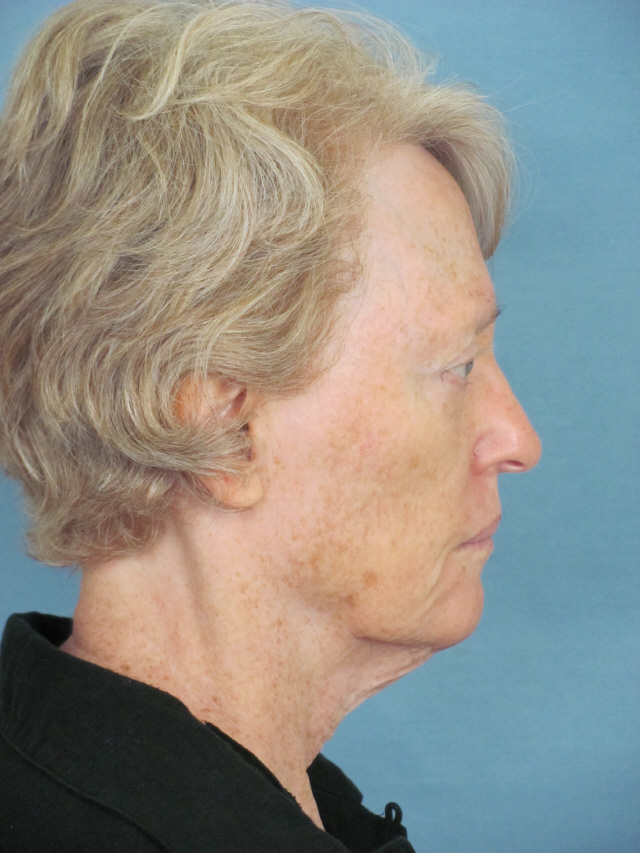 Charleston Custom Lift Facelift Before and After | Thomas Funcik MD