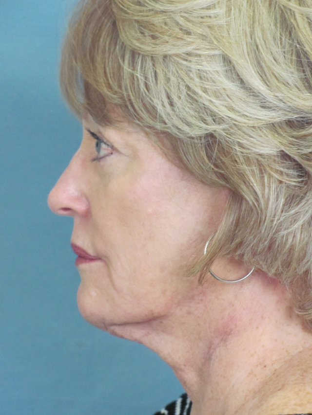 Charleston Custom Lift Facelift Before and After | Thomas Funcik MD