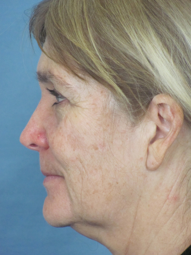 Charleston Custom Lift Facelift Before and After | Thomas Funcik MD