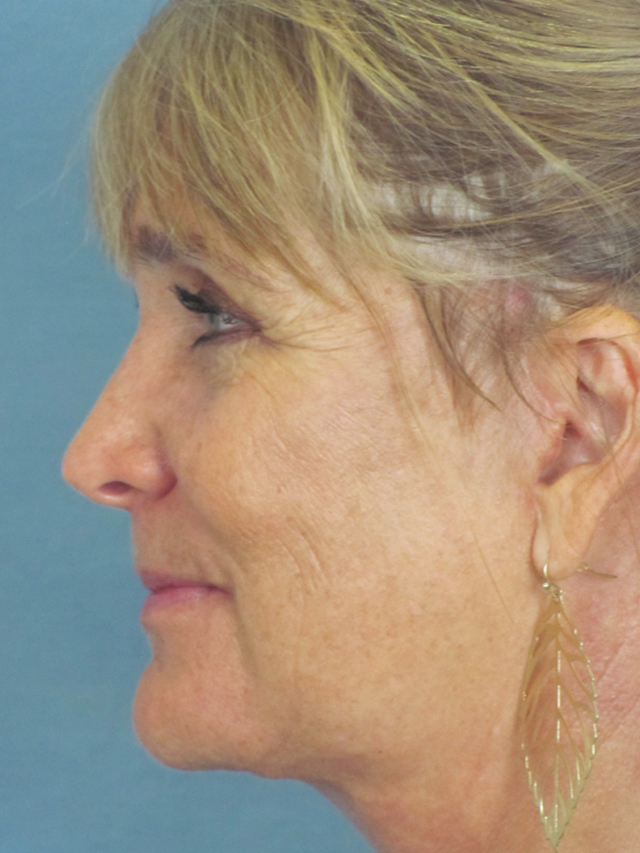 Charleston Custom Lift Facelift Before and After | Thomas Funcik MD