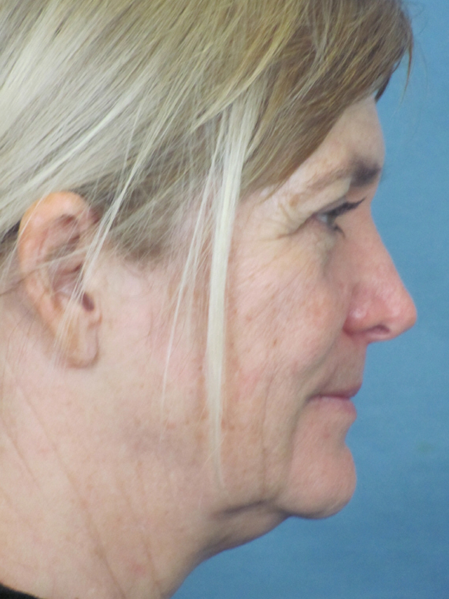 Charleston Custom Lift Facelift Before and After | Thomas Funcik MD