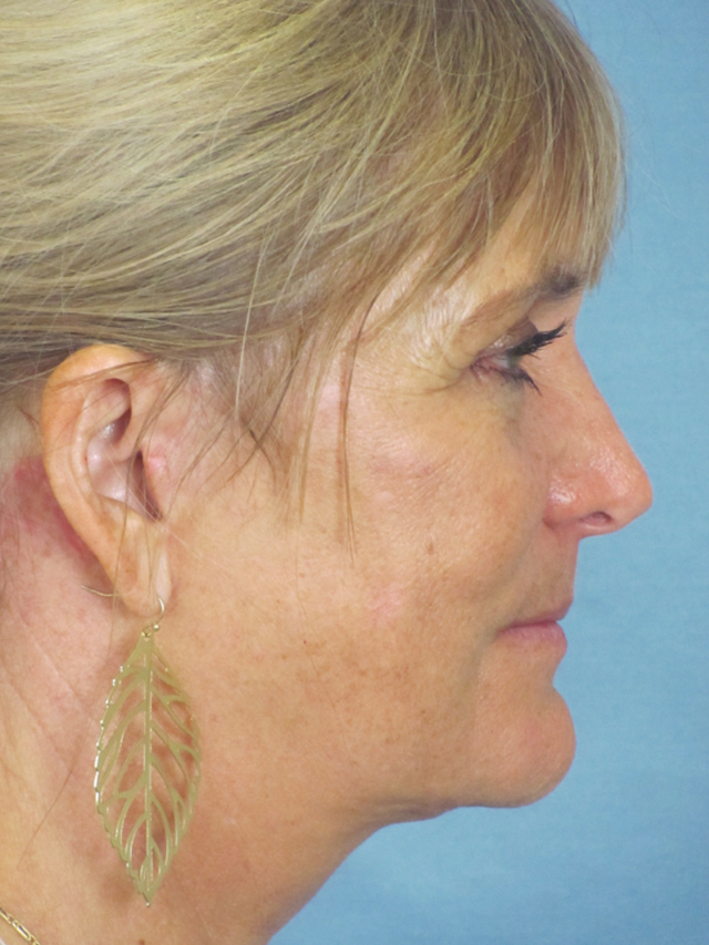 Charleston Custom Lift Facelift Before and After | Thomas Funcik MD