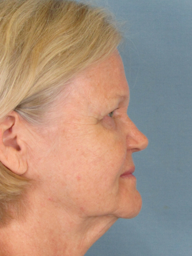 Charleston Custom Lift Facelift Before and After | Thomas Funcik MD