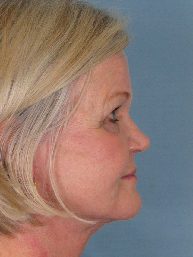 Charleston Custom Lift Facelift Before and After | Thomas Funcik MD