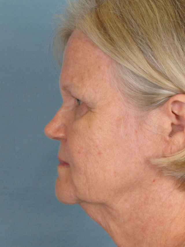 Charleston Custom Lift Facelift Before and After | Thomas Funcik MD
