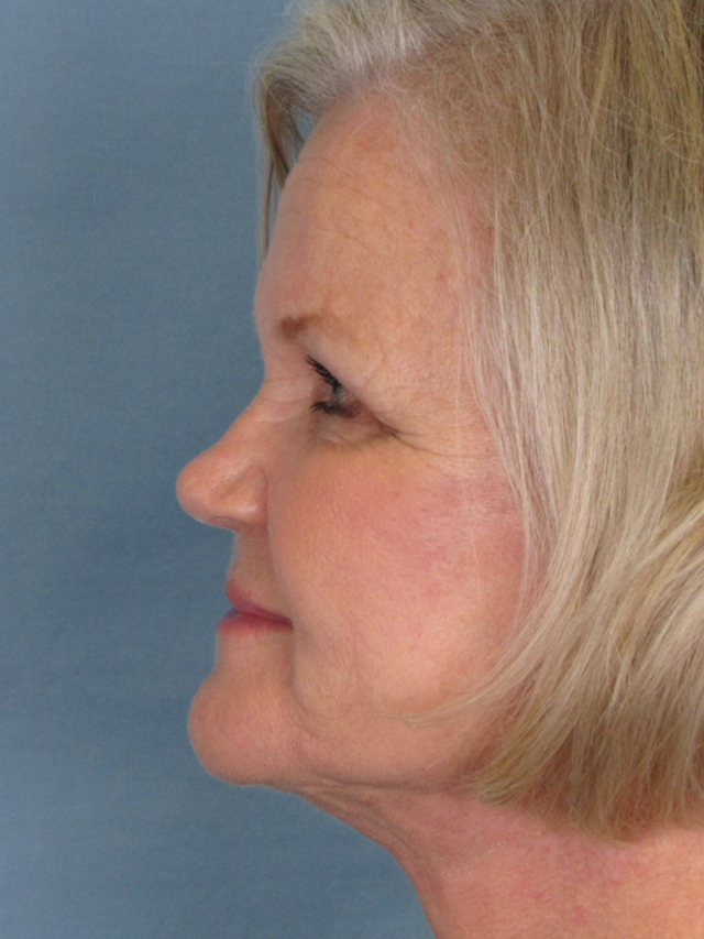 Charleston Custom Lift Facelift Before and After | Thomas Funcik MD