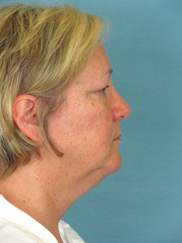 Charleston Custom Lift Facelift Before and After | Thomas Funcik MD