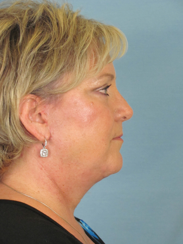 Charleston Custom Lift Facelift Before and After | Thomas Funcik MD