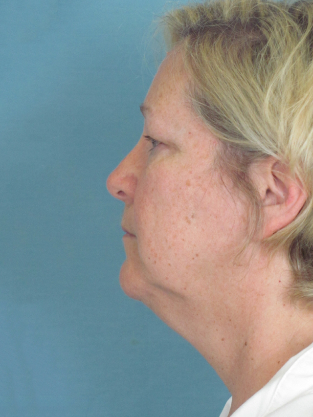 Charleston Custom Lift Facelift Before and After | Thomas Funcik MD