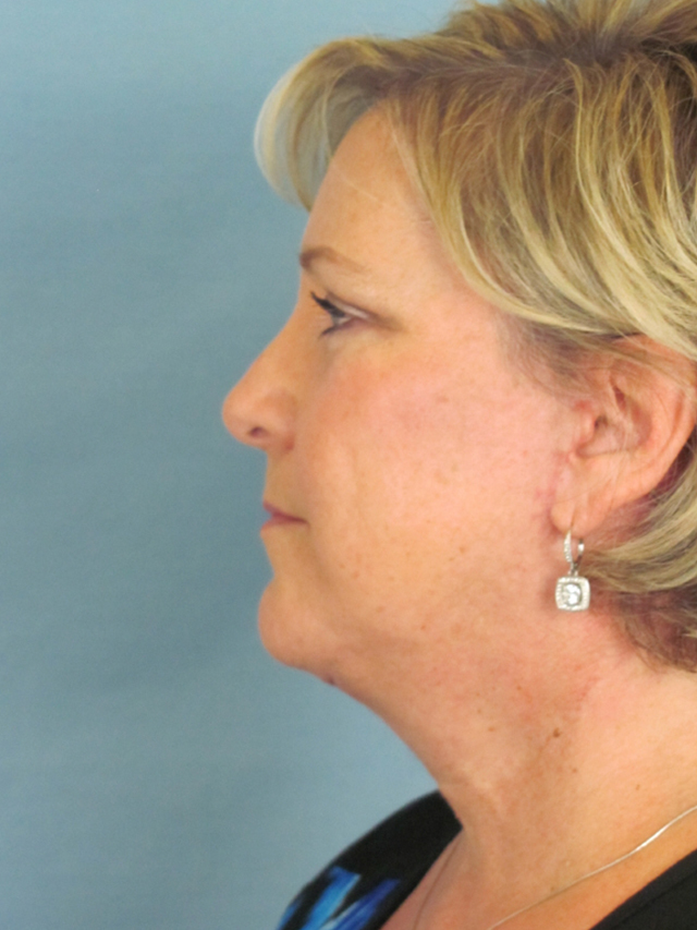 Charleston Custom Lift Facelift Before and After | Thomas Funcik MD