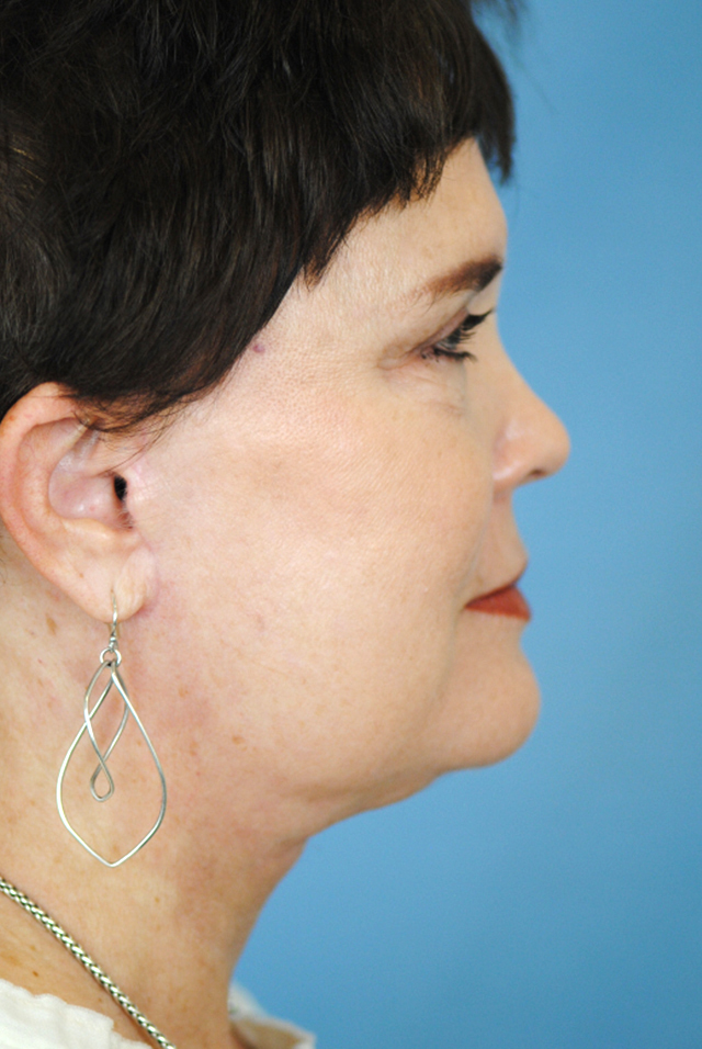 Charleston Custom Lift Facelift Before and After | Thomas Funcik MD
