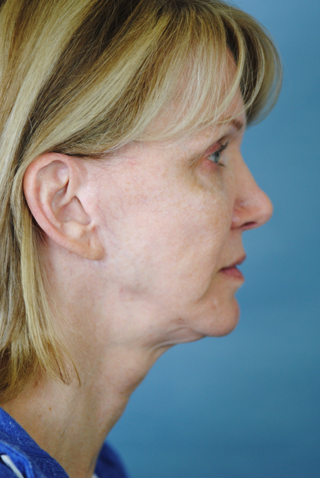 Charleston Custom Lift Facelift Before and After | Thomas Funcik MD