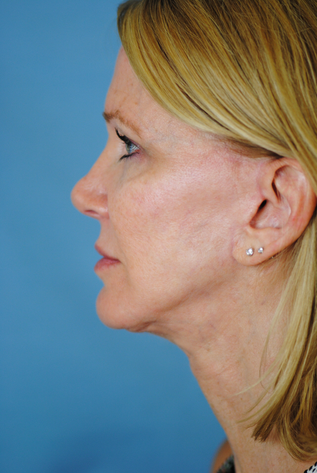 Charleston Custom Lift Facelift Before and After | Thomas Funcik MD