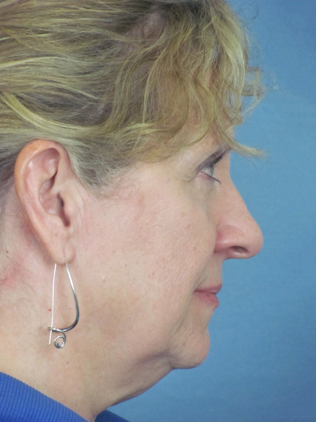 Charleston Custom Lift Facelift Before and After | Thomas Funcik MD