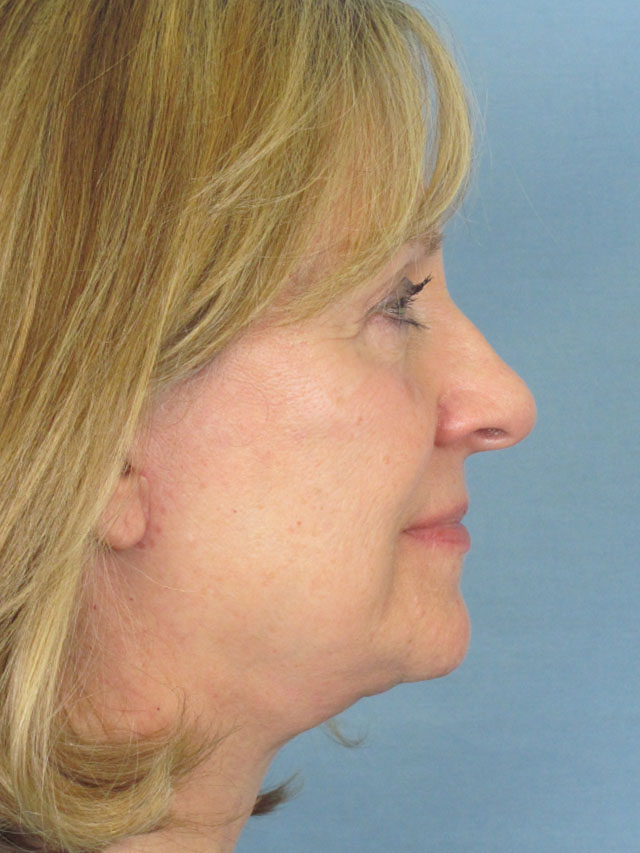 Charleston Custom Lift Facelift Before and After | Thomas Funcik MD