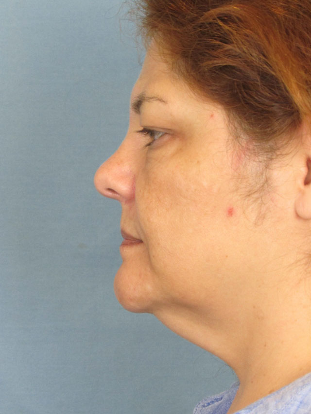 Charleston Custom Lift Facelift Before and After | Thomas Funcik MD