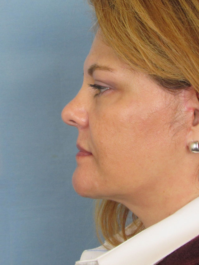 Charleston Custom Lift Facelift Before and After | Thomas Funcik MD