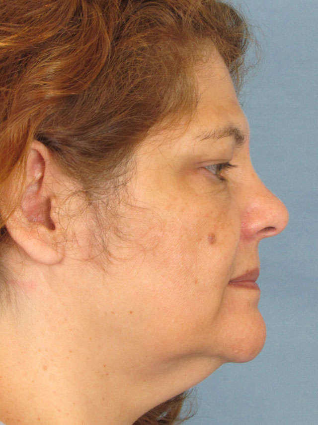 Charleston Custom Lift Facelift Before and After | Thomas Funcik MD