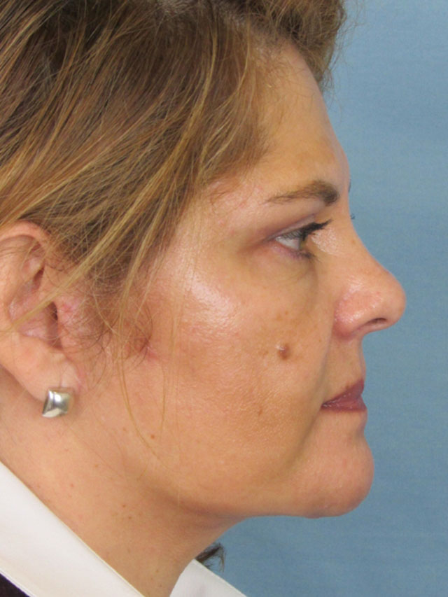 Charleston Custom Lift Facelift Before and After | Thomas Funcik MD