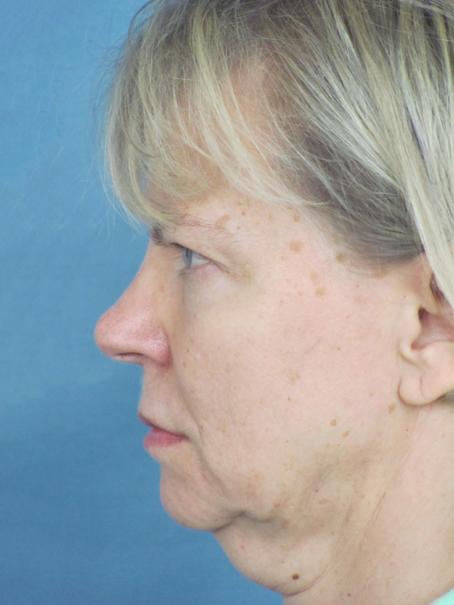 Charleston Custom Lift Facelift Before and After | Thomas Funcik MD