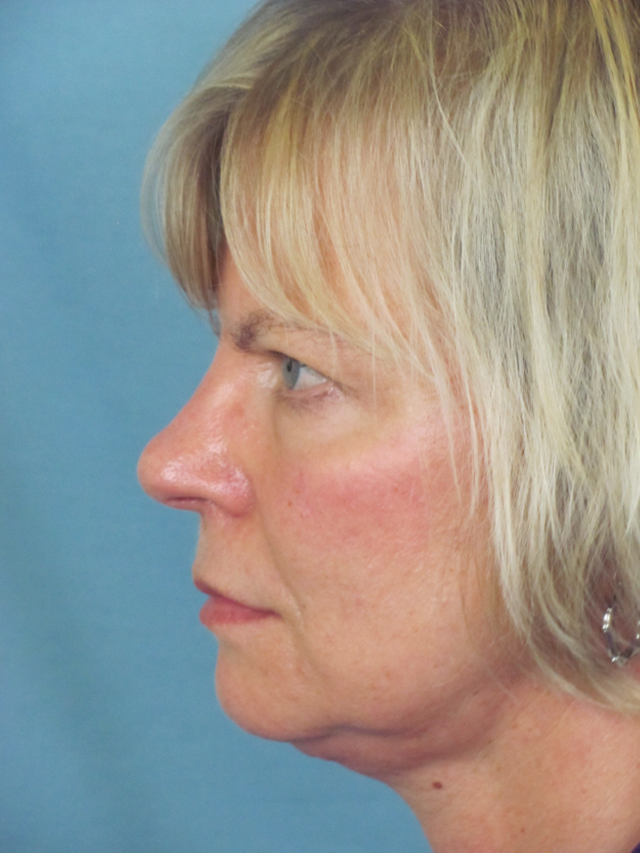 Charleston Custom Lift Facelift Before and After | Thomas Funcik MD