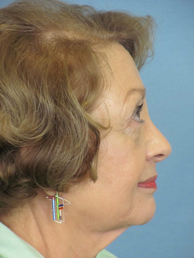 Charleston Custom Lift Facelift Before and After | Thomas Funcik MD