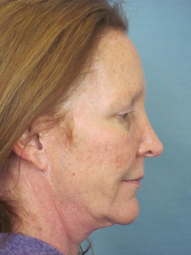 Charleston Custom Lift Facelift Before and After | Thomas Funcik MD