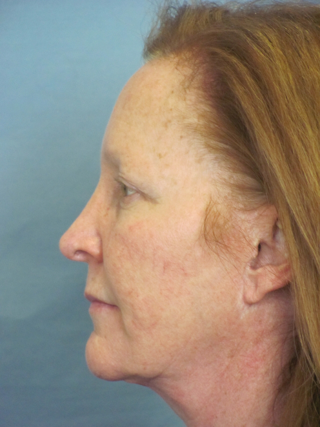 Charleston Custom Lift Facelift Before and After | Thomas Funcik MD