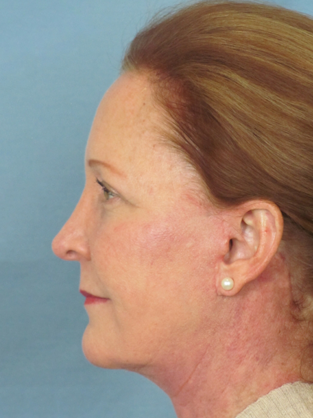 Charleston Custom Lift Facelift Before and After | Thomas Funcik MD