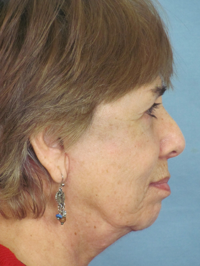 Charleston Custom Lift Facelift Before and After | Thomas Funcik MD