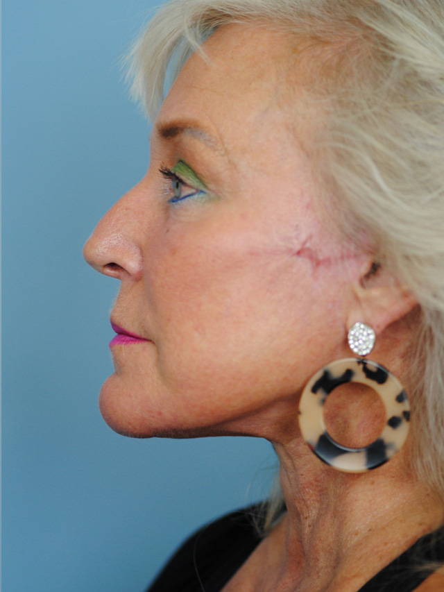 Charleston Custom Lift Facelift Before and After | Thomas Funcik MD