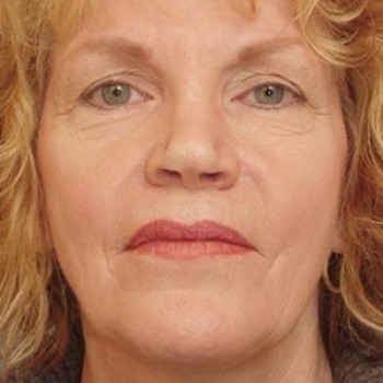 Cheek Implant Before and After | Thomas Funcik MD