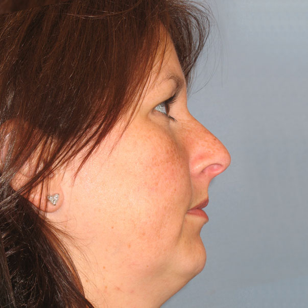 Chin Implant Before and After | Thomas Funcik MD