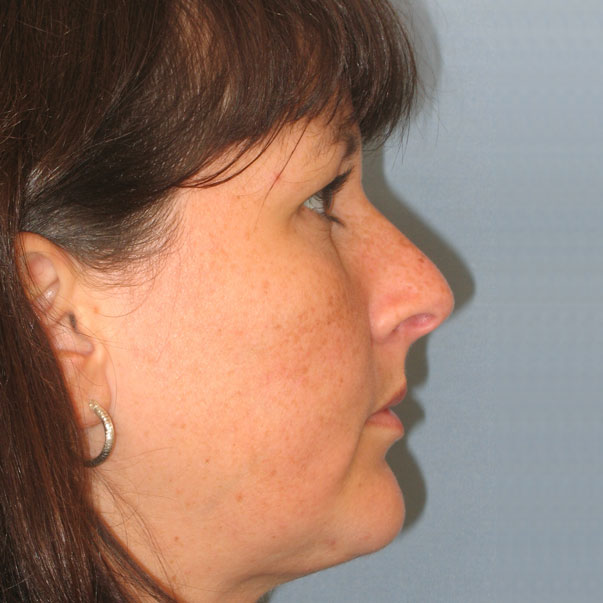 Chin Implant Before and After | Thomas Funcik MD