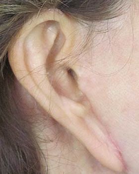 Complications Of Facial Surgery Before and After | Thomas Funcik MD