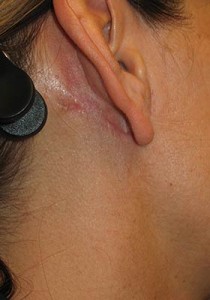 Complications Of Facial Surgery Before and After | Thomas Funcik MD