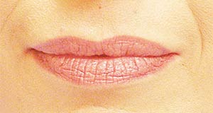 Lip Augmentation Before and After | Thomas Funcik MD