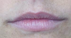 Lip Augmentation Before and After | Thomas Funcik MD