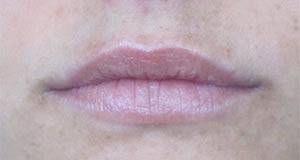 Lip Augmentation Before and After | Thomas Funcik MD