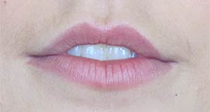 Lip Augmentation Before and After | Thomas Funcik MD