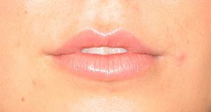 Lip Augmentation Before and After | Thomas Funcik MD