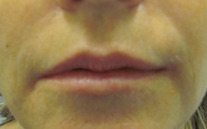 Lip Augmentation Before and After | Thomas Funcik MD