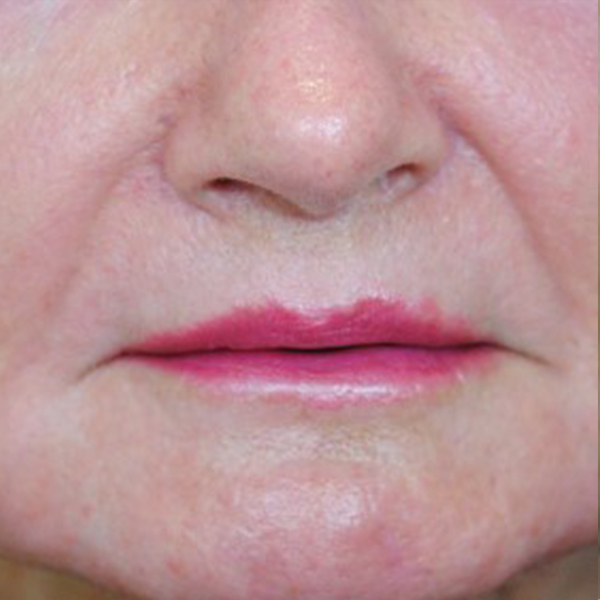 Lip Lift Before and After | Thomas Funcik MD