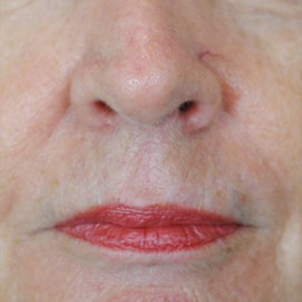 Lip Lift Before and After | Thomas Funcik MD