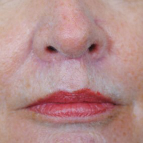 Lip Lift Before and After | Thomas Funcik MD